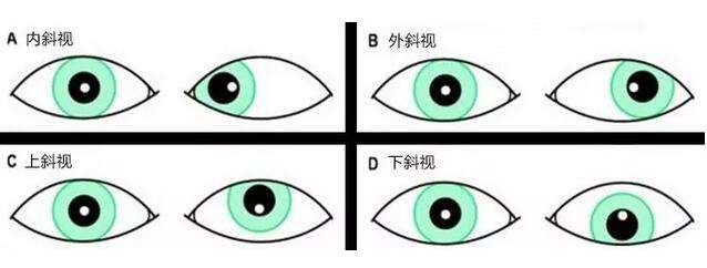 十二岁孩子眼睛斜视怎么办,天天宅在家里怎么办