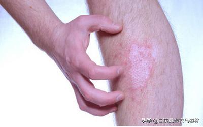 治疗白癜风是真的吗,治疗白癜风的药为什么都伤肝