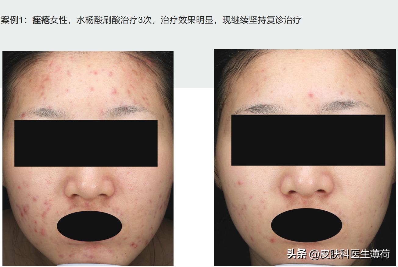 水杨酸精华果酸去闭口粉刺,刷酸去黑头收缩毛孔用哪个产品好