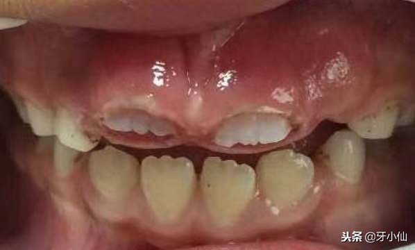 小孩牙长不出来割一下需要多少钱,儿童畸形牙拔了不长怎么办