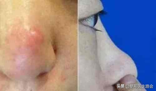 隆鼻后鼻尖发红按起疼怎么处理,隆鼻后鼻尖发紫是怎么回事