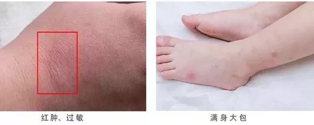 蚊虫叮咬后能用烫伤膏吗,烫伤烧伤瘙痒蚊虫叮咬用什么药膏