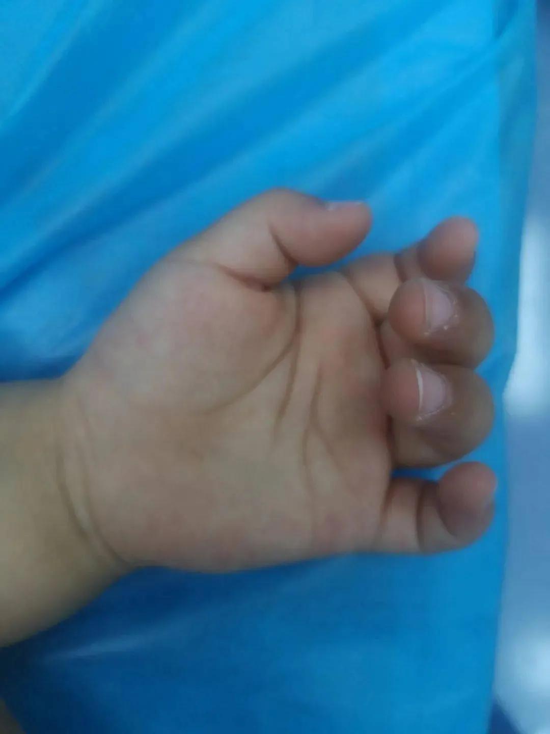 宝宝手指突发腱鞘炎,孩子手指突然伸不直疼