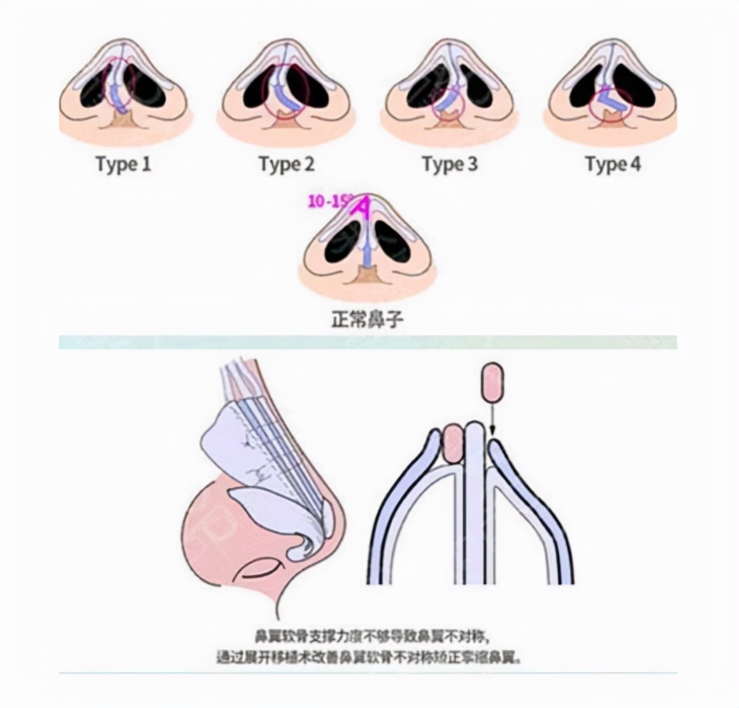 唇裂鼻畸形的最佳修复时间,唇裂科普视频