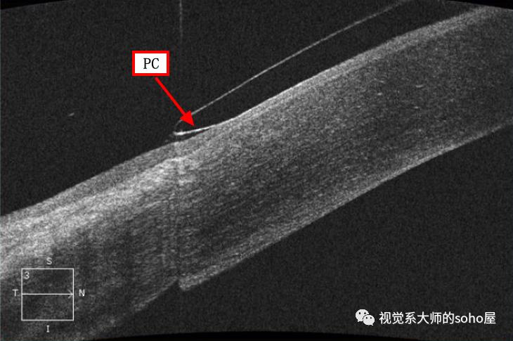 视光方面的知识,视光眼科科普