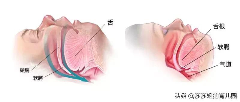 张嘴呼吸一定是腺样体肥大吗,张口呼吸一定会腺样体面容吗