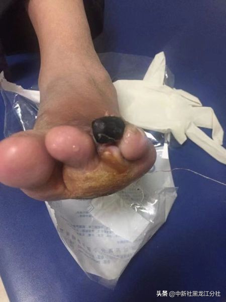 鞋子挤脚导致指甲变形,抠脚导致截肢