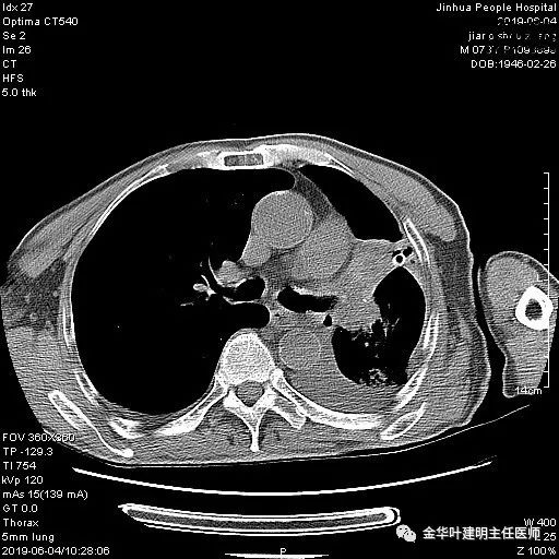 手术引起乳糜胸,有没有做了肺结节手术后是误诊的