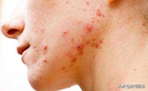 皮肤换季爆痘怎么办,皮肤换季干燥敏感爆痘怎么办