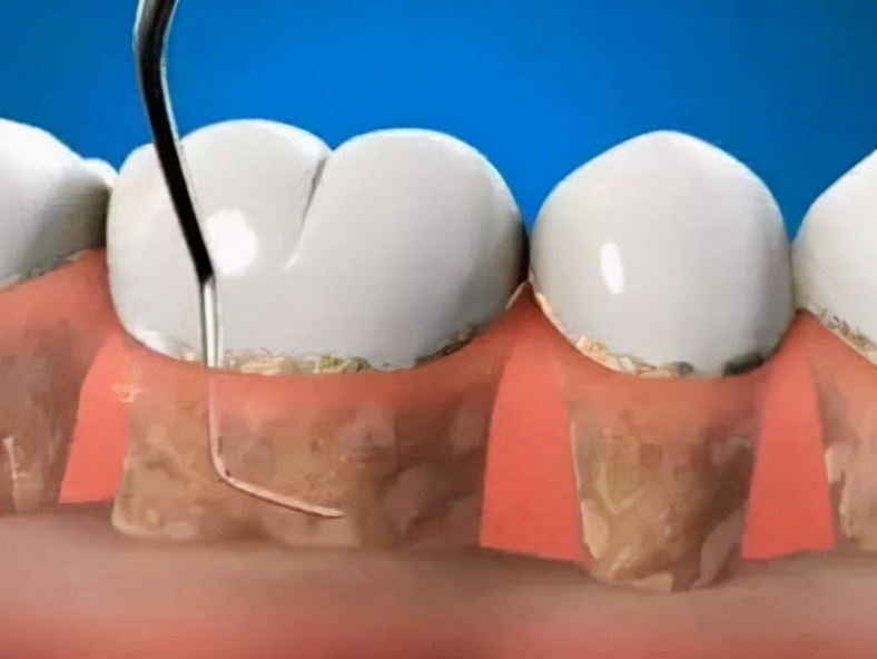 一招解决所有口臭,一招解决口臭困扰