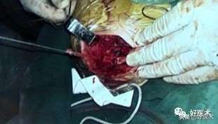 治疗肩锁关节脱位，有最好的方法吗？