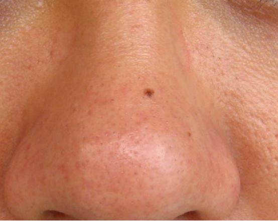 浣跨敤绮夊簳娑插彲浠ユ敼鍠勯粦澶翠箞,榛戝ご涓ラ噸鐢ㄤ粈涔堢矇搴曟恫