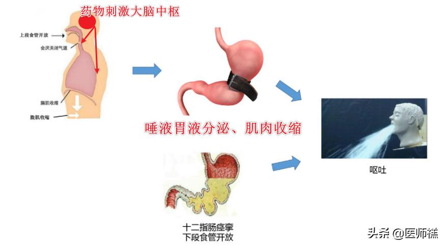 化疗呕吐处方药,化疗药物引起的恶心呕吐的科普