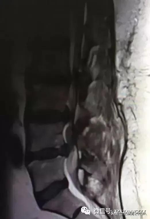 弯腰捡东西,腰痛腿麻大小便*禁失**,竞是腰椎间盘髓核脱出惹的祸