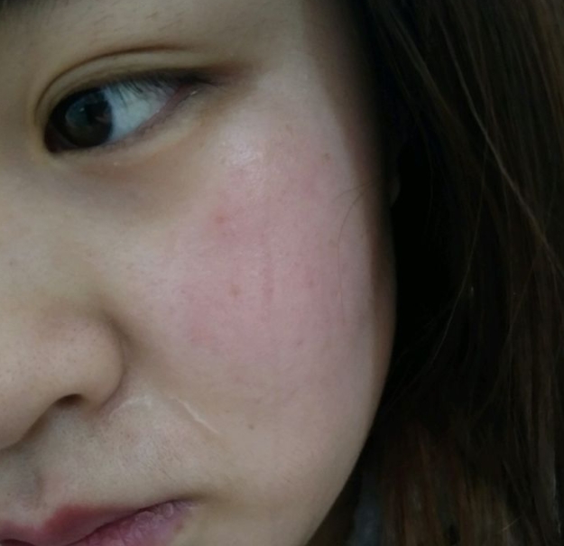 角质层薄冬天脸容易红怎么保护,皮肤容易泛红角质层薄怎么护理