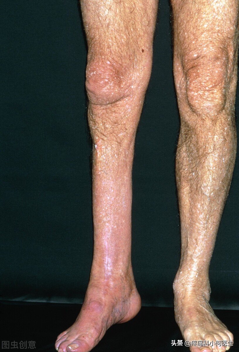 骨折后两脚大小不一样怎么办,骨折后左右腿长度不一能恢复吗