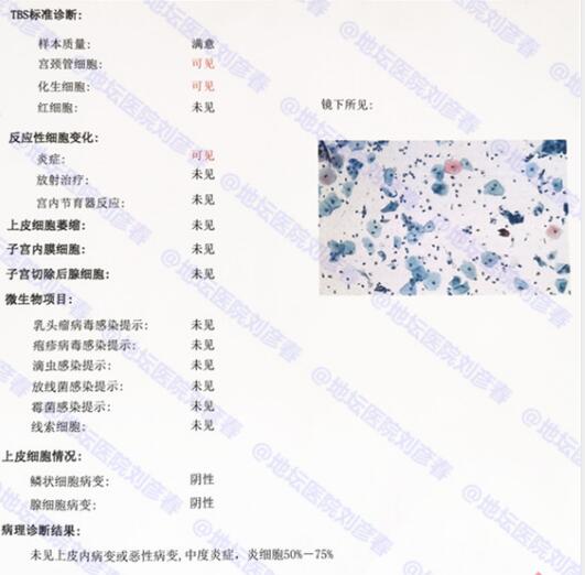 tct炎症反应性细胞改变需要治疗吗,tct显示中度炎症妇科怎么治疗