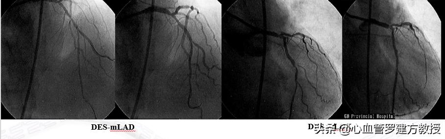 得了腹主动脉瘤该怎么治疗,腹主动脉血管狭窄怎么治疗