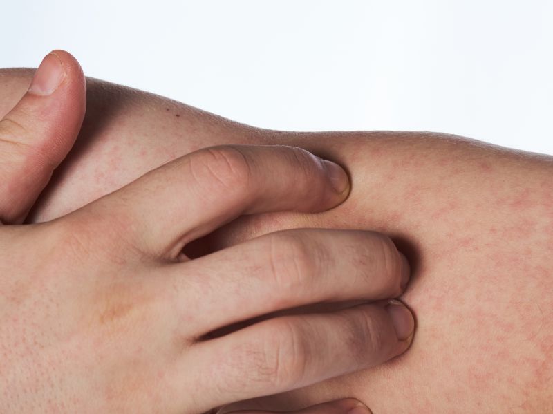 过敏性皮肤病需要吃什么药治疗呢,过敏性皮肤病的中医治法