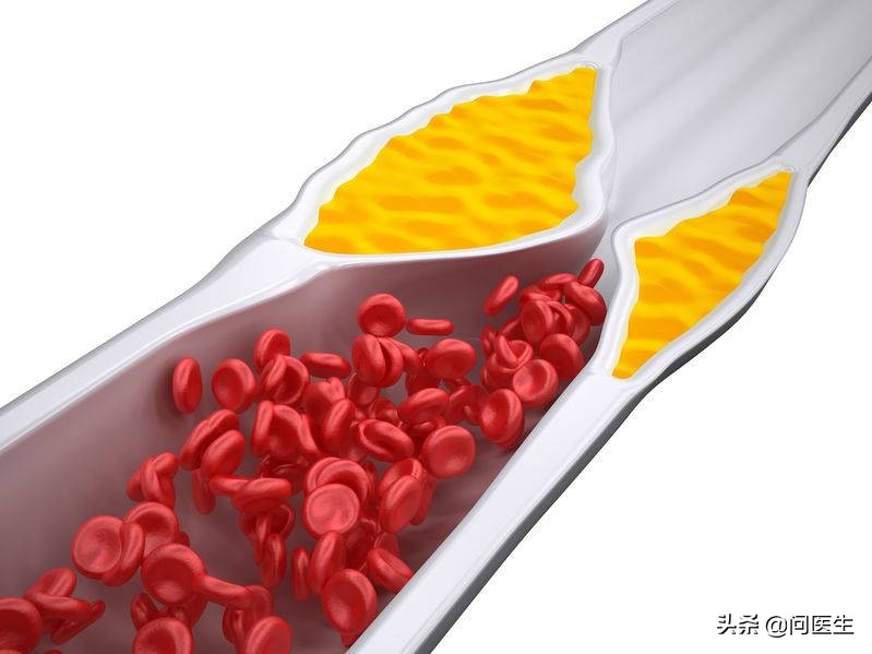 血脂胆固醇甘油三酯都高怎么办,血脂胆固醇甘油三酯高怎么调理