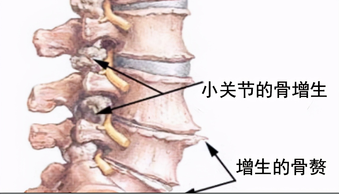 脊椎骨质增生吃什么中药,脊柱骨质增生怎么锻炼视频