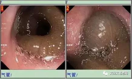 吓人!广南一男子气管内发现6厘米蚂蟥,文山人注意了……