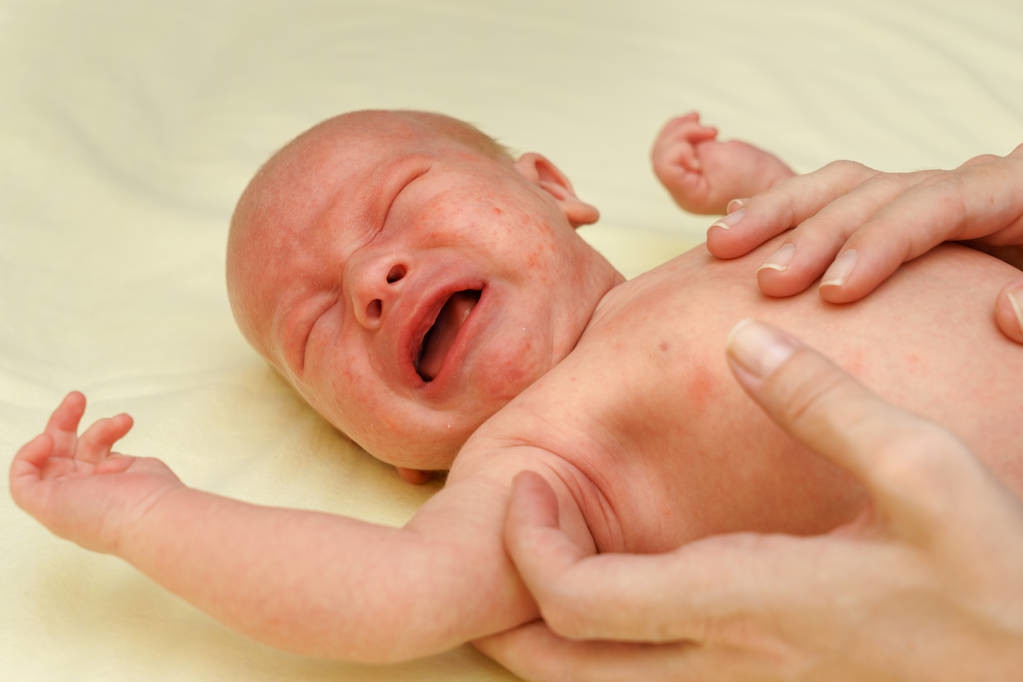 新生儿湿疹妈妈哺乳注意什么,宝宝有湿疹可以打麻腮风吗