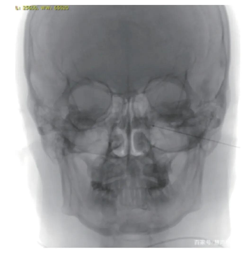 过敏性鼻炎引起的疼痛怎么缓解,过敏性鼻炎难受时怎么能缓解