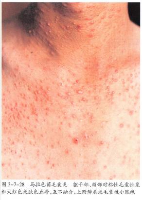 前胸后背的痘疤怎么去除,前胸后背长痘涂什么药膏