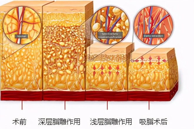 吸脂手术多久可以正常活动,吸脂手术多久可以恢复