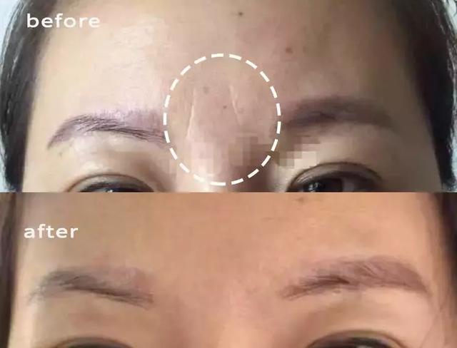 硬刚女皇龙妈也扛不住法令纹，2条沟壑让人心疼，贴一贴就消了