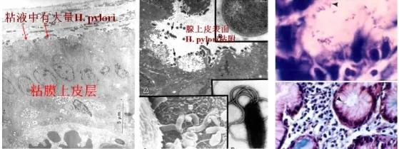 胃黏膜有炎症的表现,胃黏膜炎症的症状是什么引起的