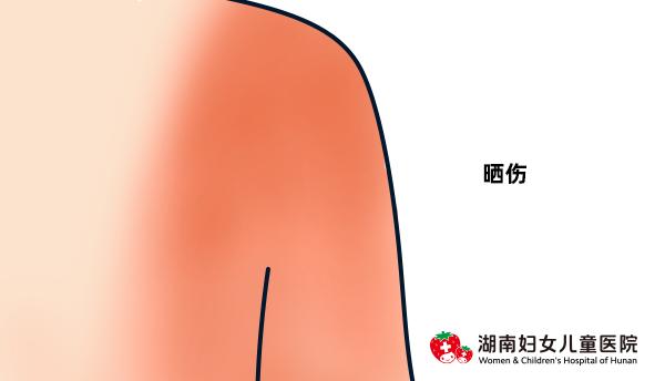 小孩夏天怎么防止痒疹,夏天的宝宝怎么避免热疹