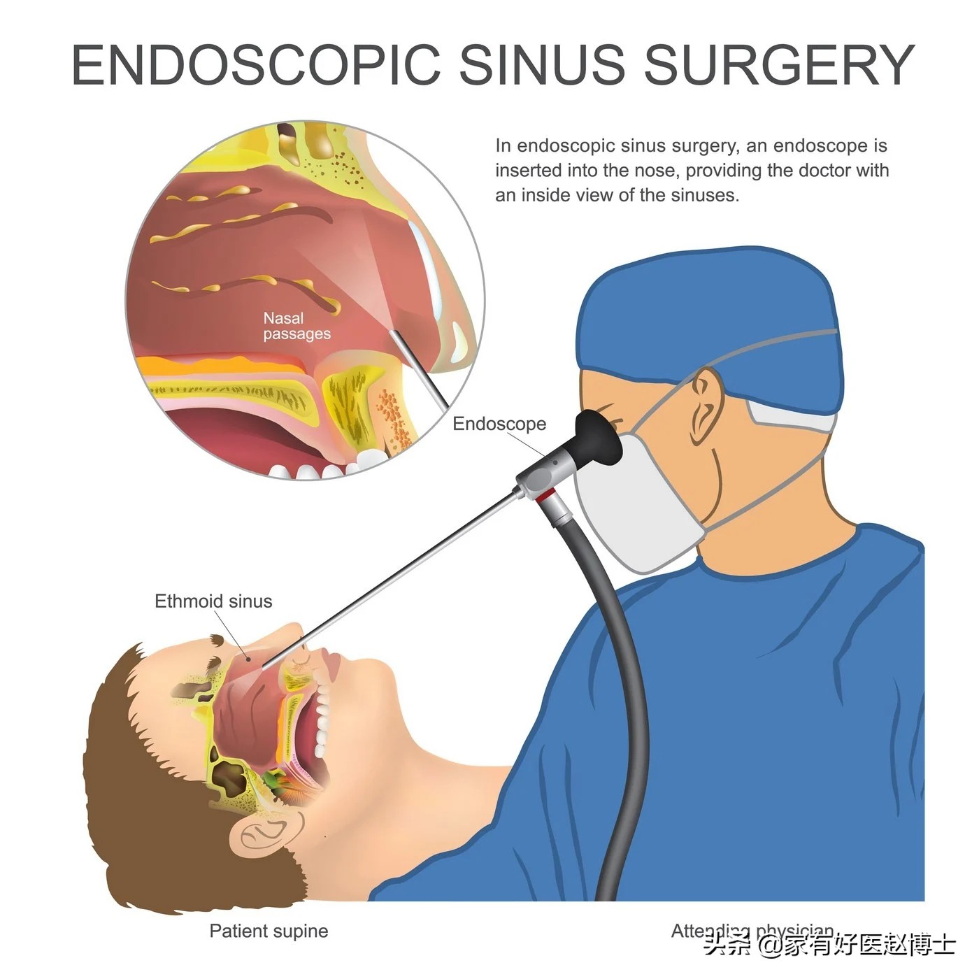 最常见5类息肉每个人都可能有，哪些无癌变风险，哪些需要切除？