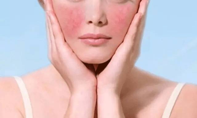 红血丝正确护肤方法,脸色红血丝多是不是护肤品不适合