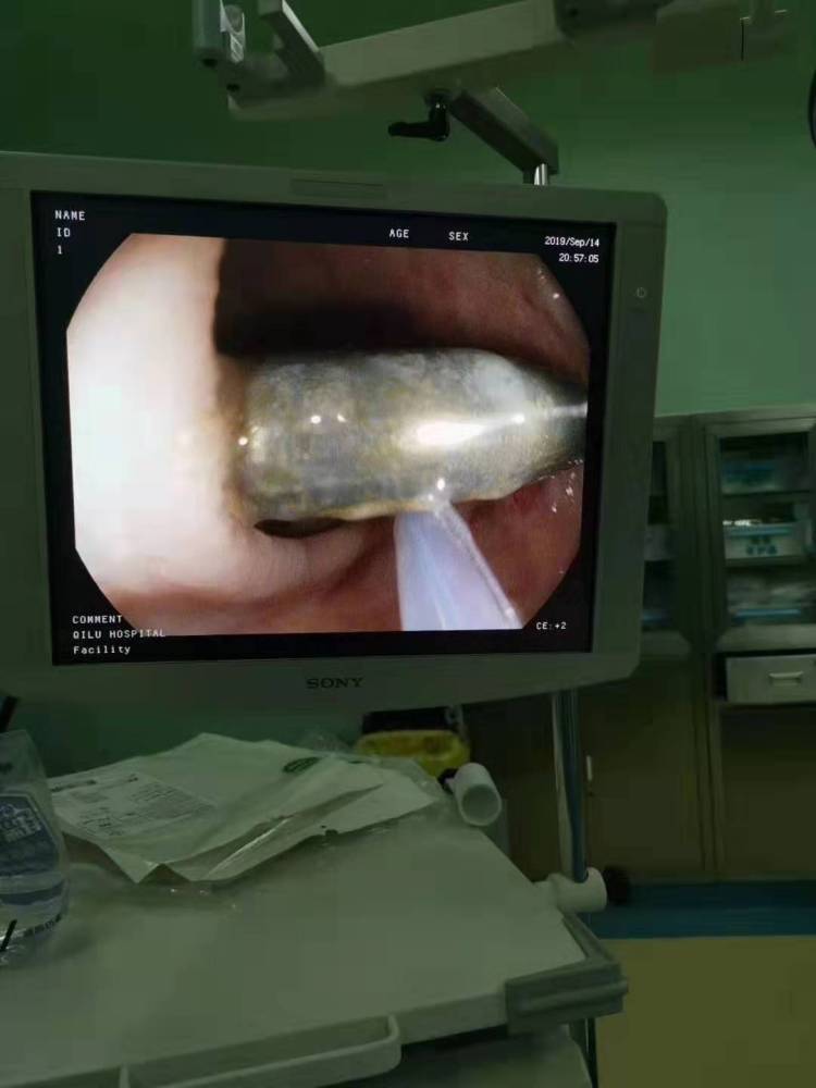 4岁男孩吞2cm钉子,4岁男孩吞下一颗5厘米钢钉