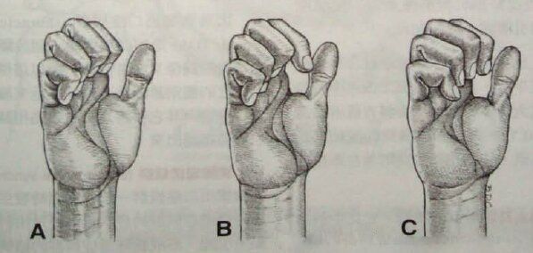 前中斜角综合症,前中斜角肌间沟有多长