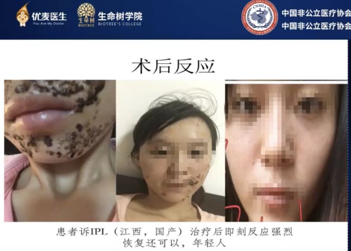 哪种医美项目祛痘印最有效,最有效的医美抗衰项目