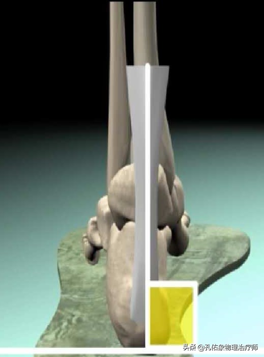 如何治疗足底筋膜炎缓解疼痛,足跟痛筋膜炎最佳的治疗办法