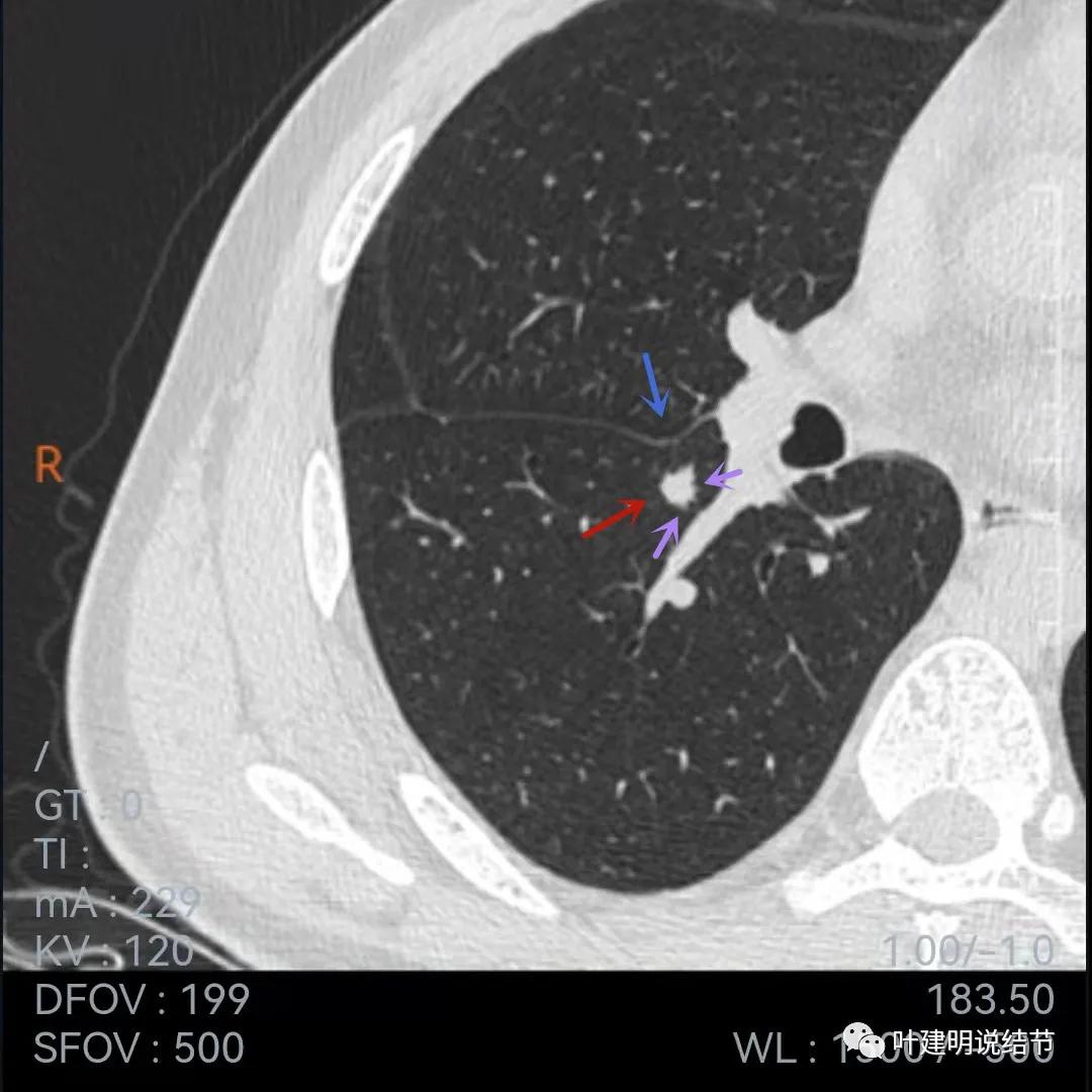 问诊分析：存在了4年的实性结节会不会是肺癌？