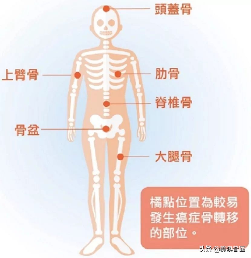 肺癌晚期骨转移有必要化疗吗,肺癌晚期出现骨转移该怎么办