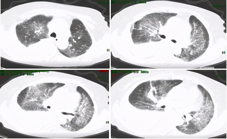 胸腔积液并有顽固性咳嗽,胸腔积液无症状