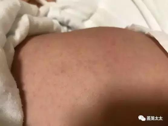 干性湿疹怎么护理和治疗,手湿疹怎么治疗和护理