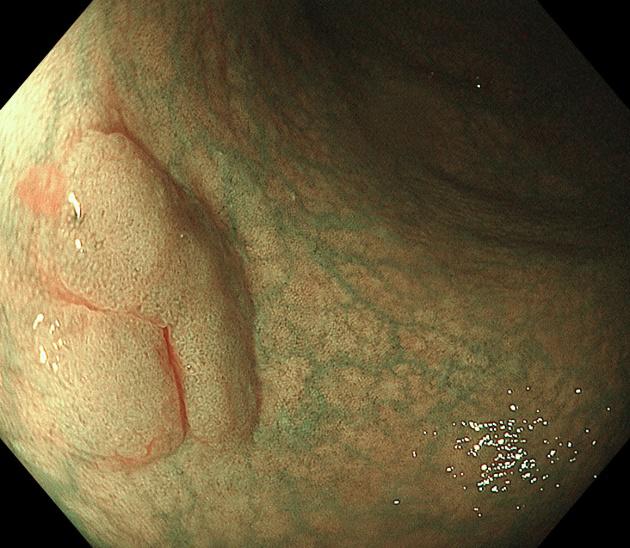 良性肿瘤也可用内镜下黏膜剥离术,内镜下粘膜剥离术后残留肿瘤