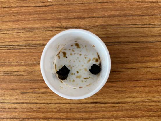 怎么减少胆囊结石发作,胆囊结石不控制还会继续长大吗