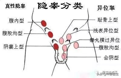 7岁男孩从出生就摸不到*丸睾**听信7岁才手术,专家:晚了,终身不育