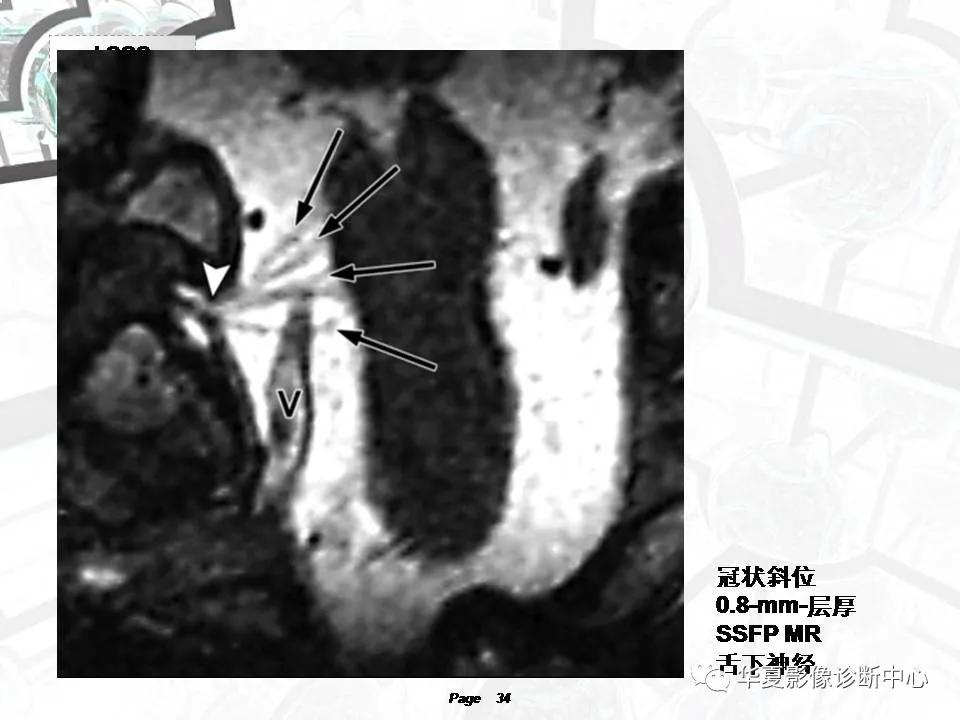 磁共振颅神经扫描是定位在哪,颅神经图谱