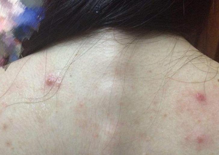 后背长痘痘怎么办最有用的方法,后背长痘痘怎么快速解决