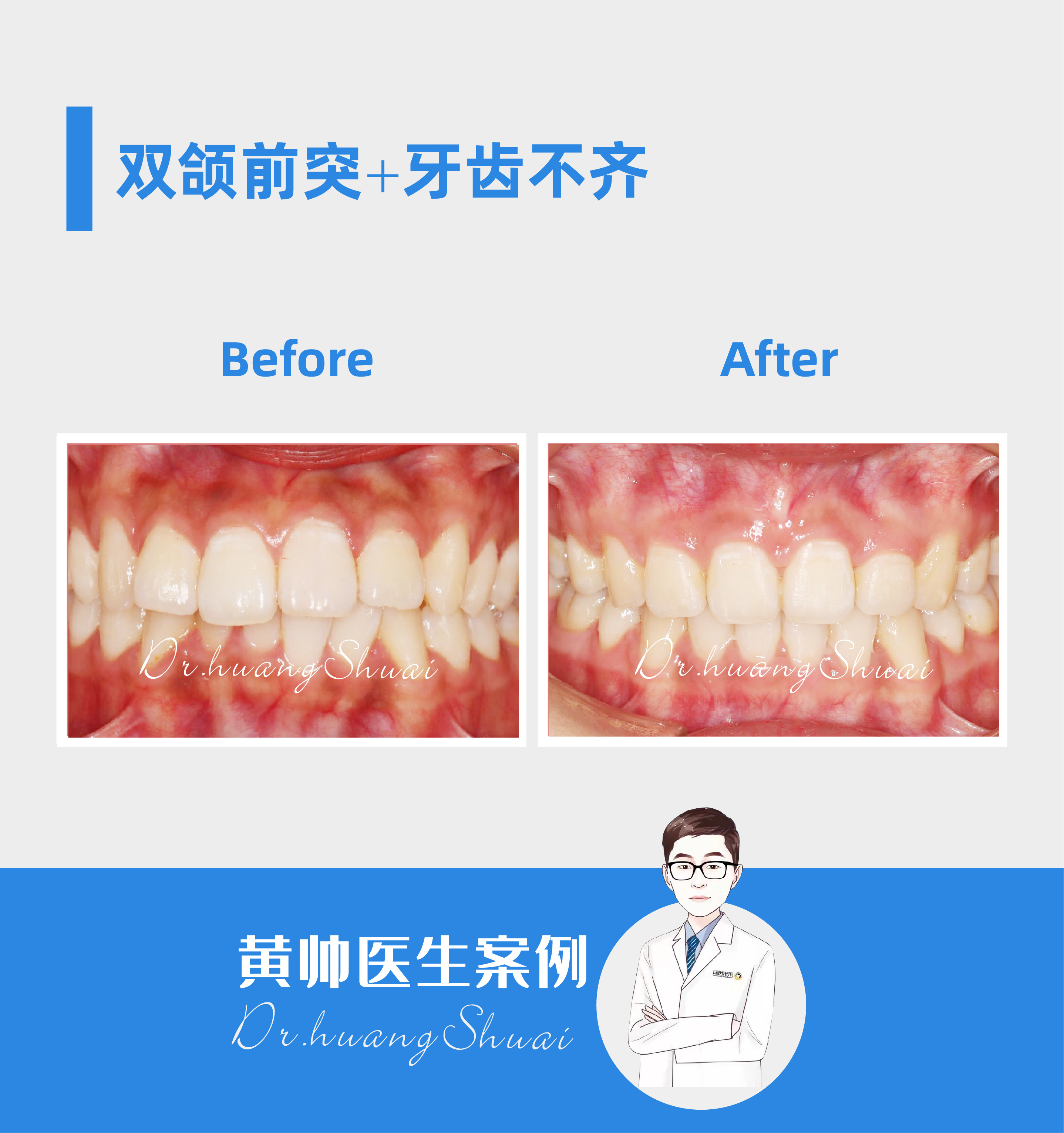 嘴凸牙齿矫正前后对比视频,牙齿矫正拔智齿可以怎样改善嘴凸