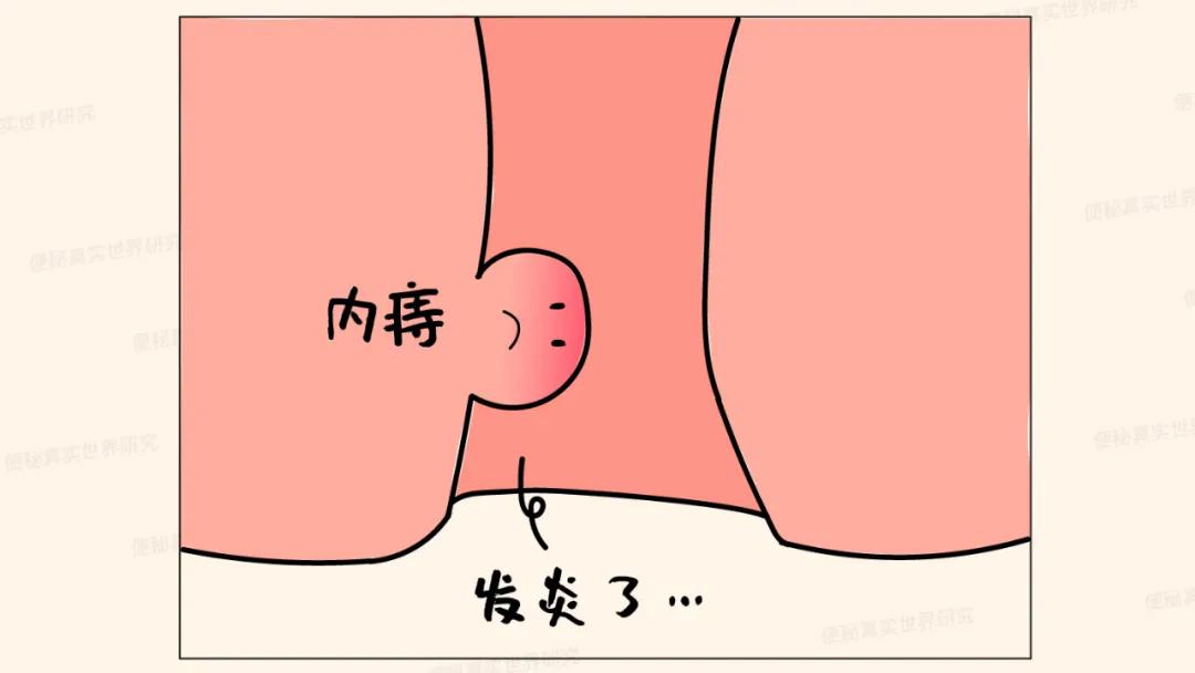 便秘肛门口堵得慌,便秘导致肛门堵得难受